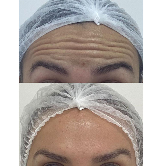 TOXINA BOTULÍNICA “BOTOX”