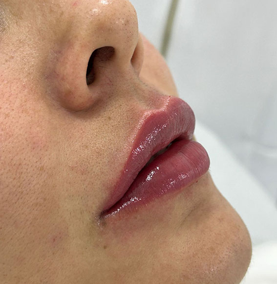 PREECHIMENTO FACIAL